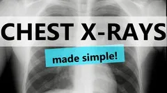 chest-x-ray-interpretation-11014