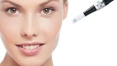 microneedling-treatment-15585